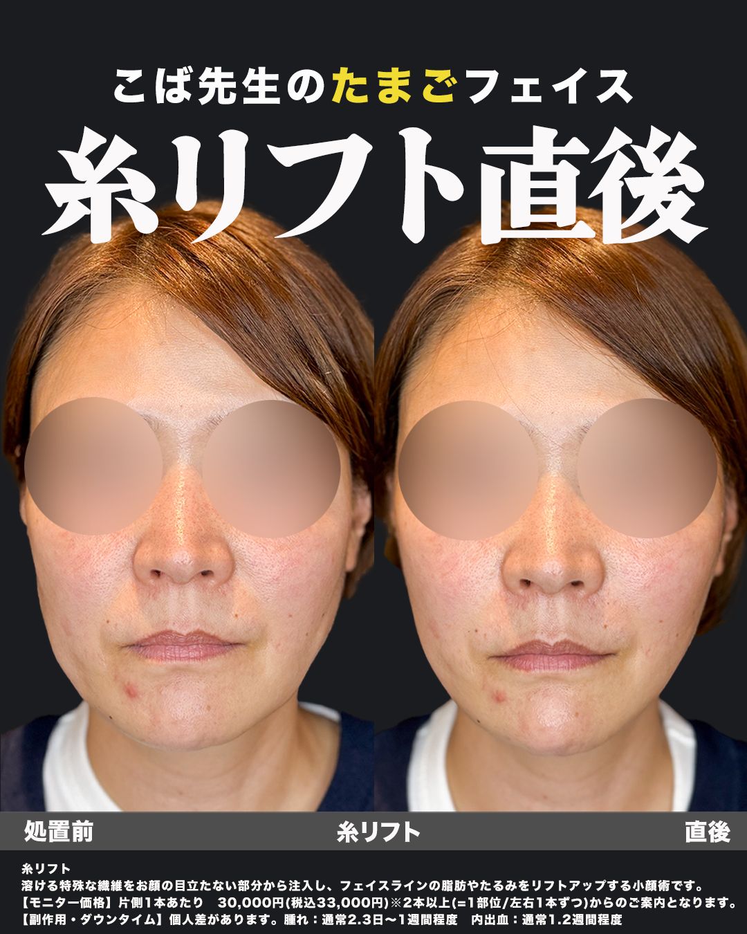 糸リフトの症例写真24（正面）