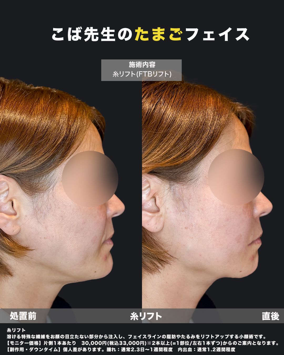 糸リフトの症例写真24（横）