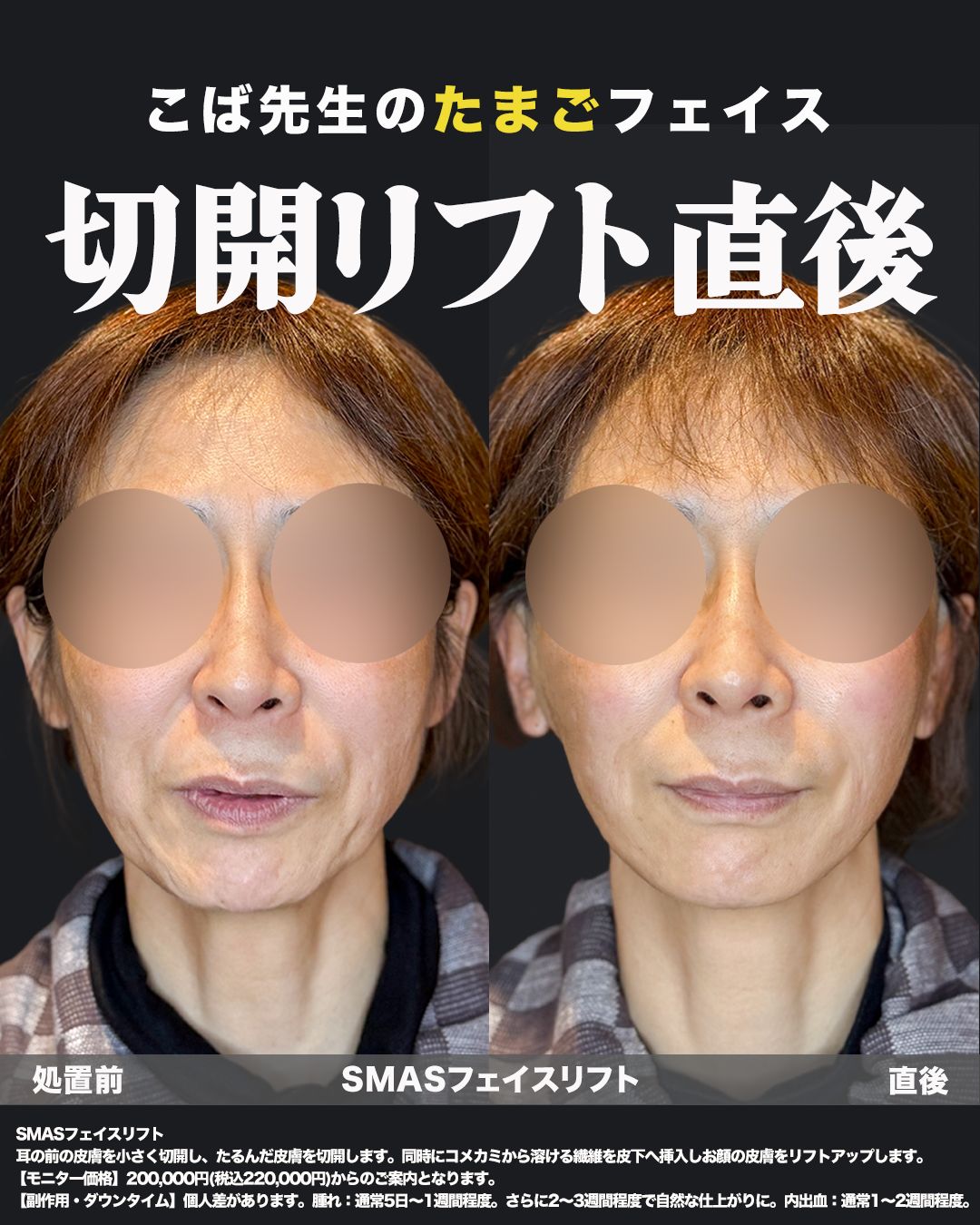 切開式フェイスリフト症例26 - 女性、50代（正面）