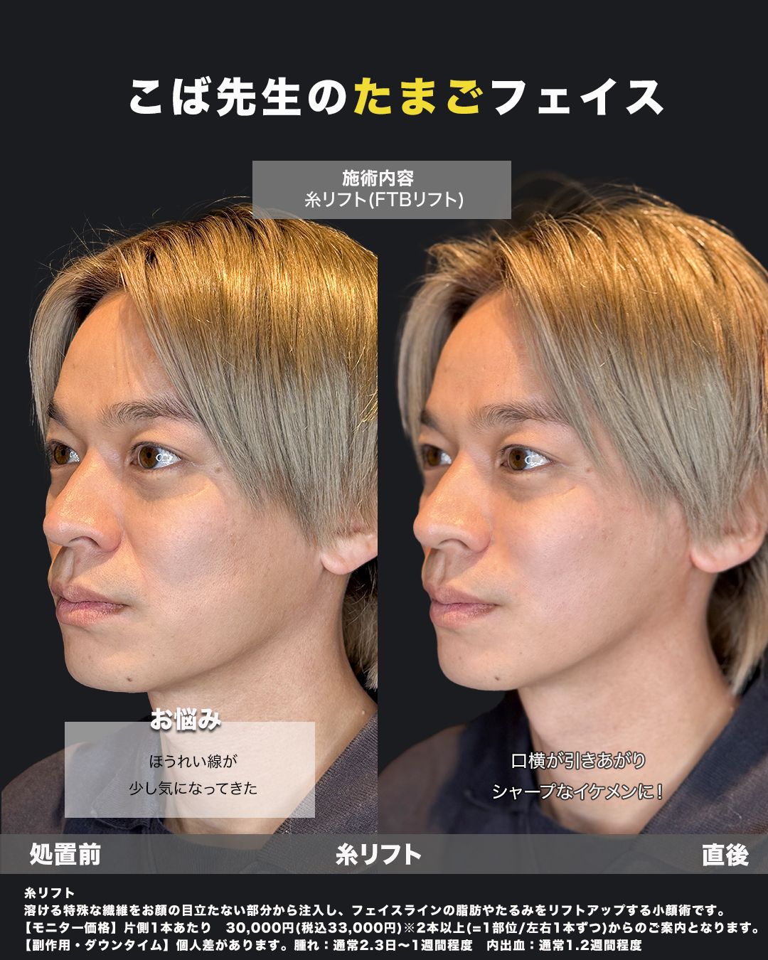 糸リフト直後の症例34（斜め）