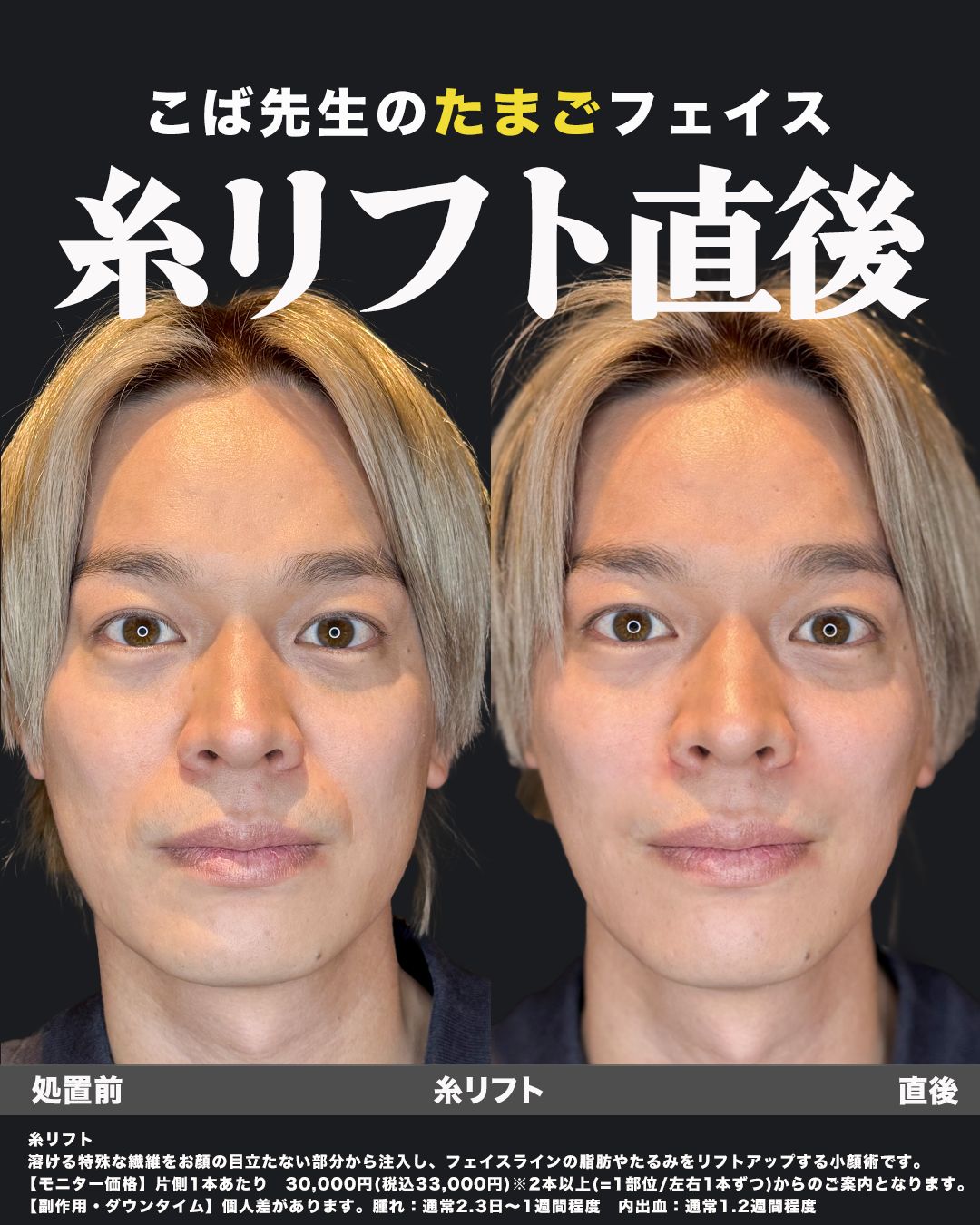 糸リフト直後の症例34（正面）