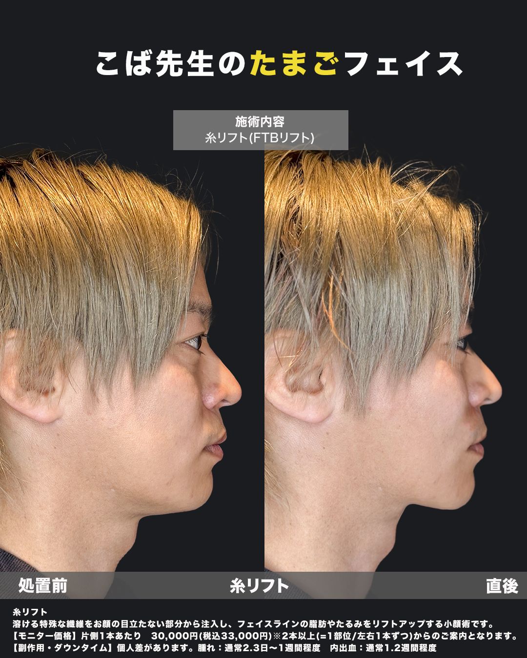 糸リフト直後の症例34（横）