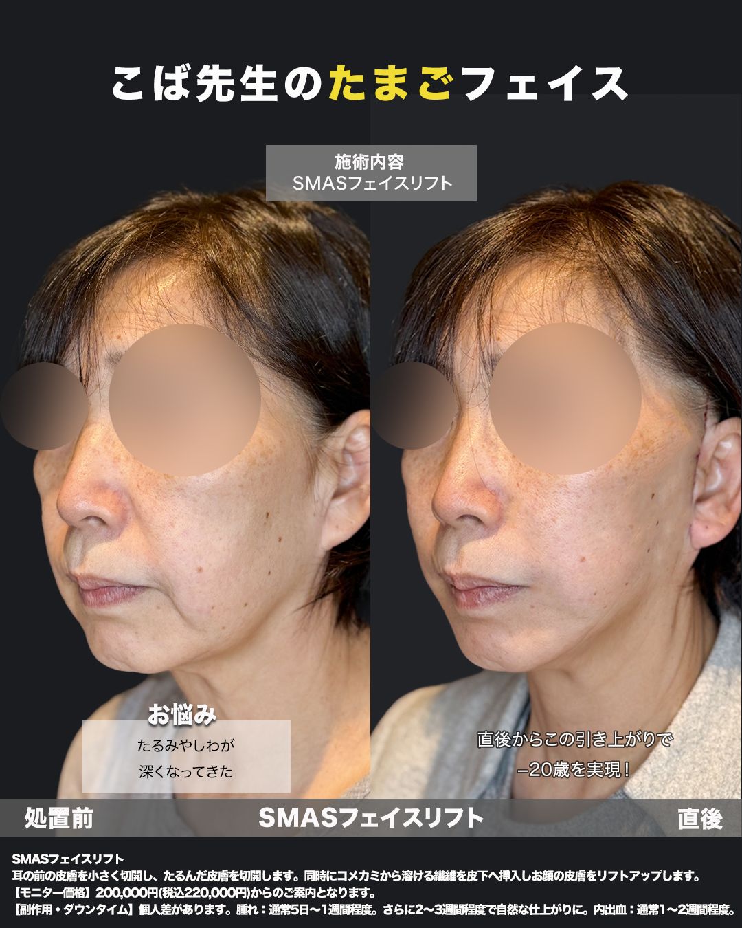 切開リフト症例30 _ 60代女性（斜め）