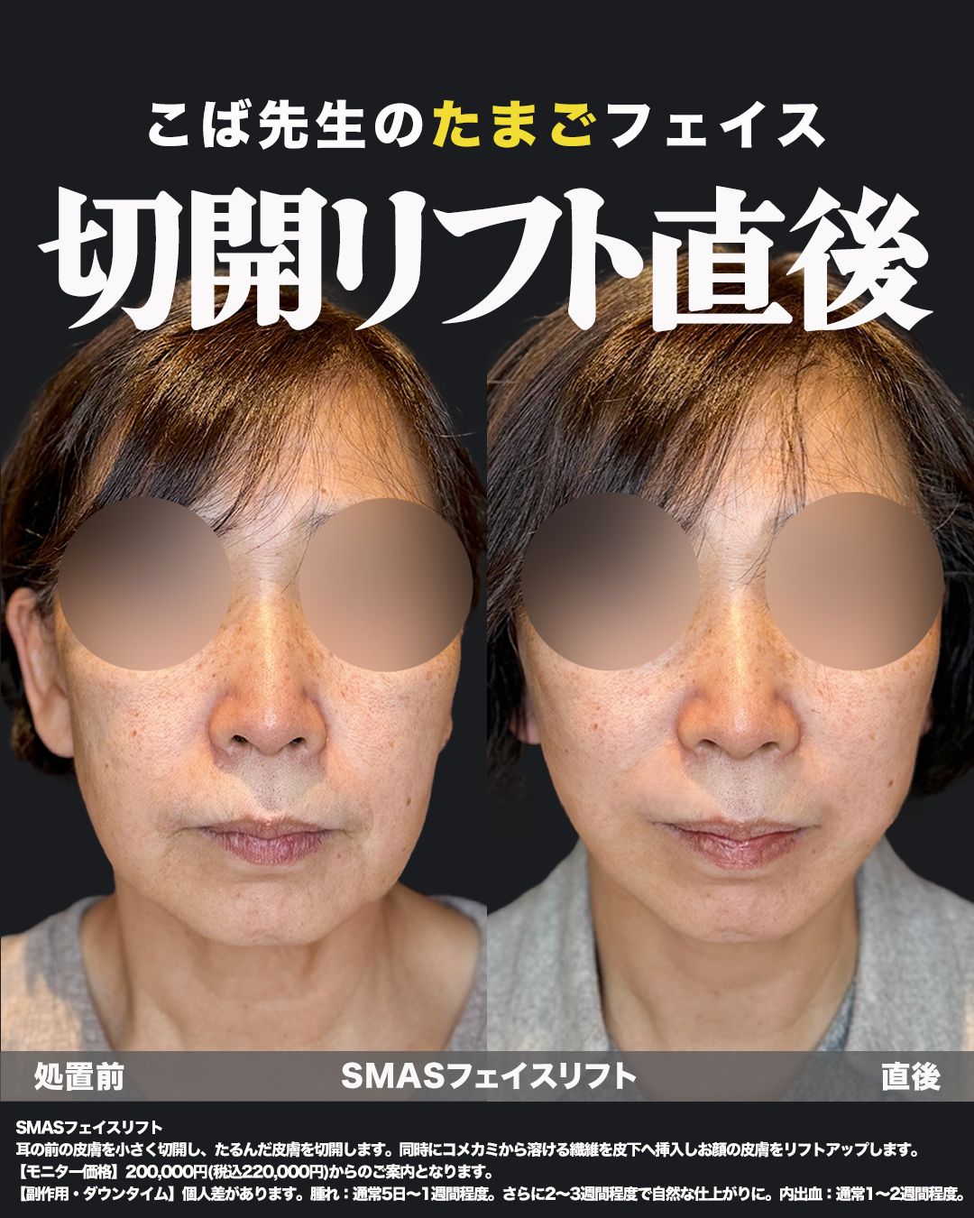 切開リフト症例30 _ 60代女性（正面）