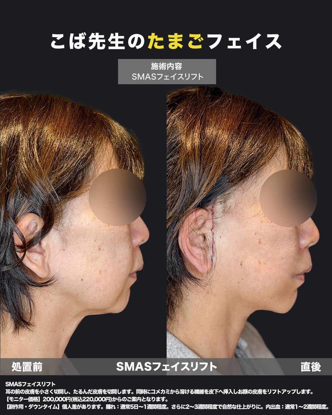 切開リフト症例30 _ 60代女性（横）