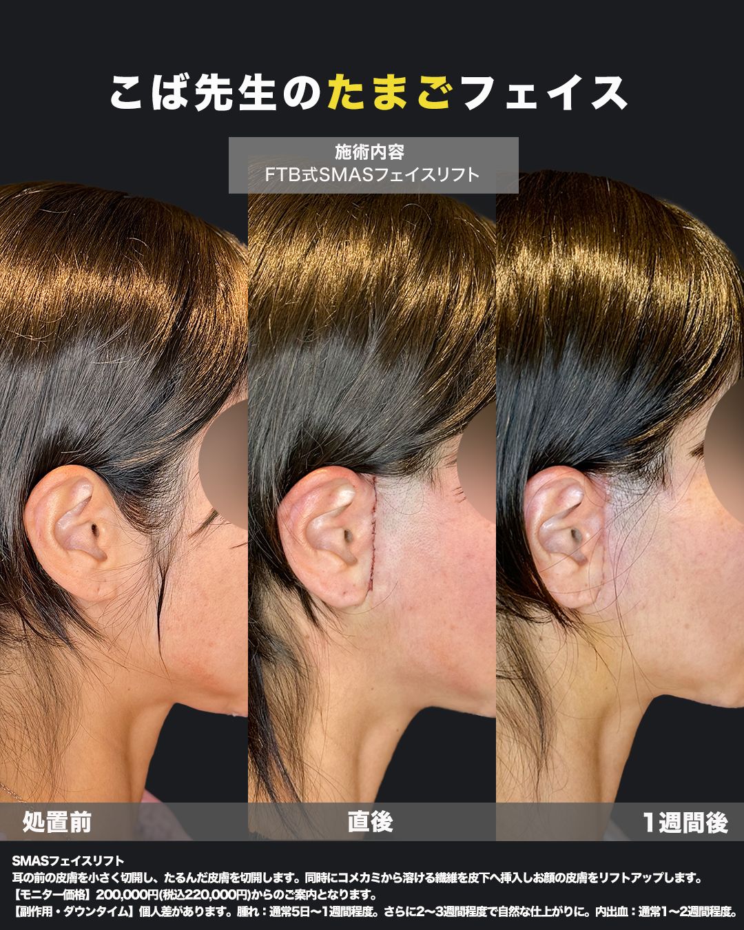 切開リフト症例25 _ 40代女性（比較）