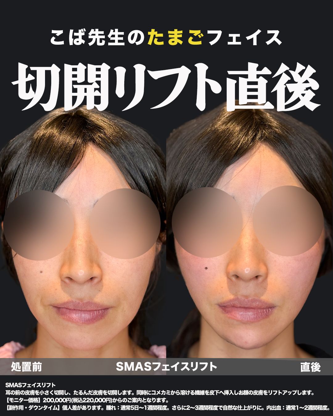 切開リフト症例25 _ 40代女性（正面）