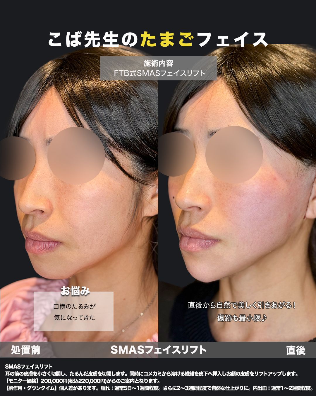 切開リフト症例25 _ 40代女性（斜め）