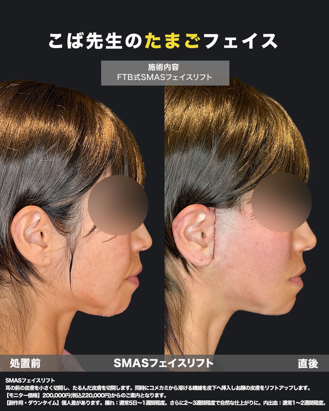 切開リフト症例25 _ 40代女性（横）