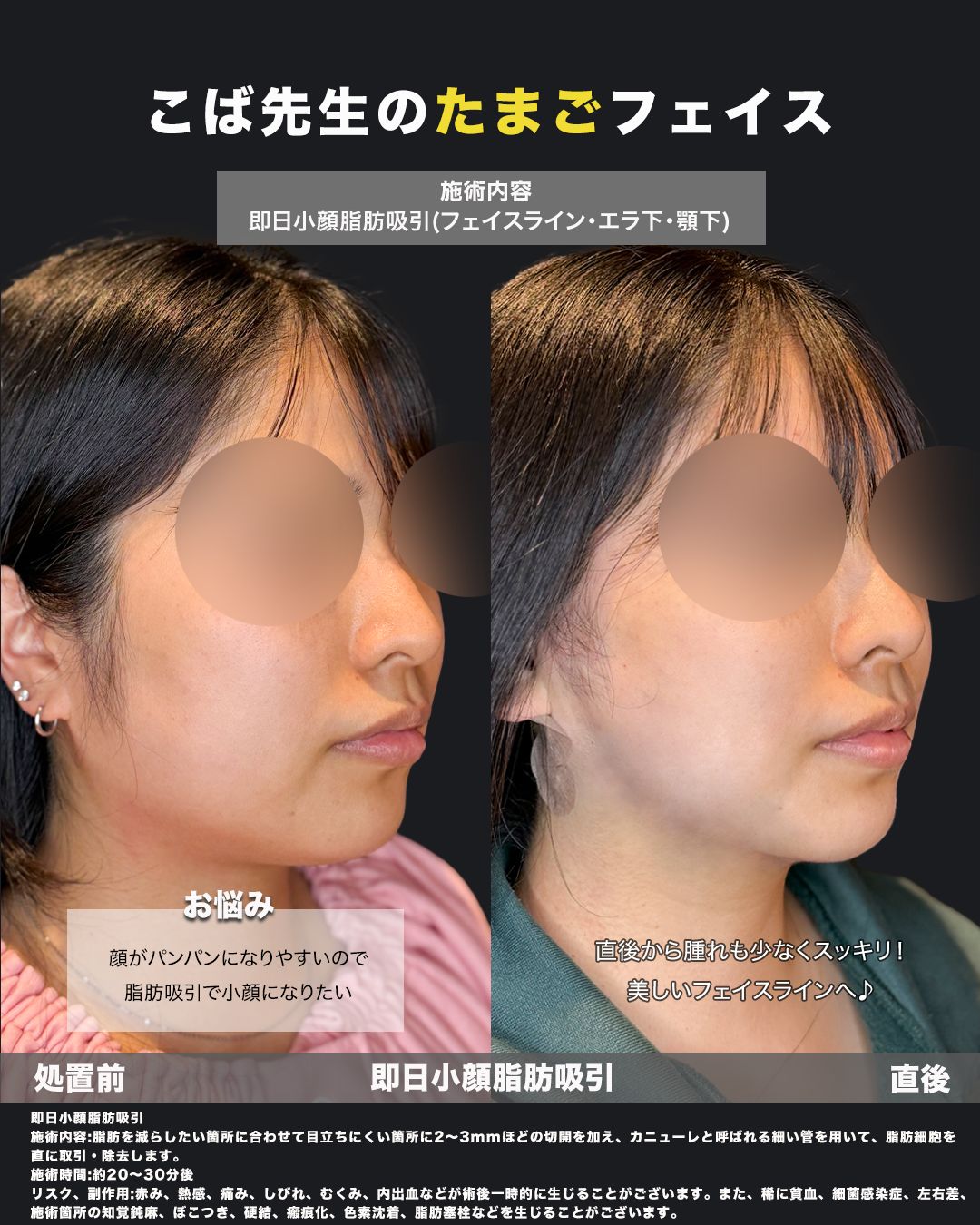 脂肪吸引症例63-斜め