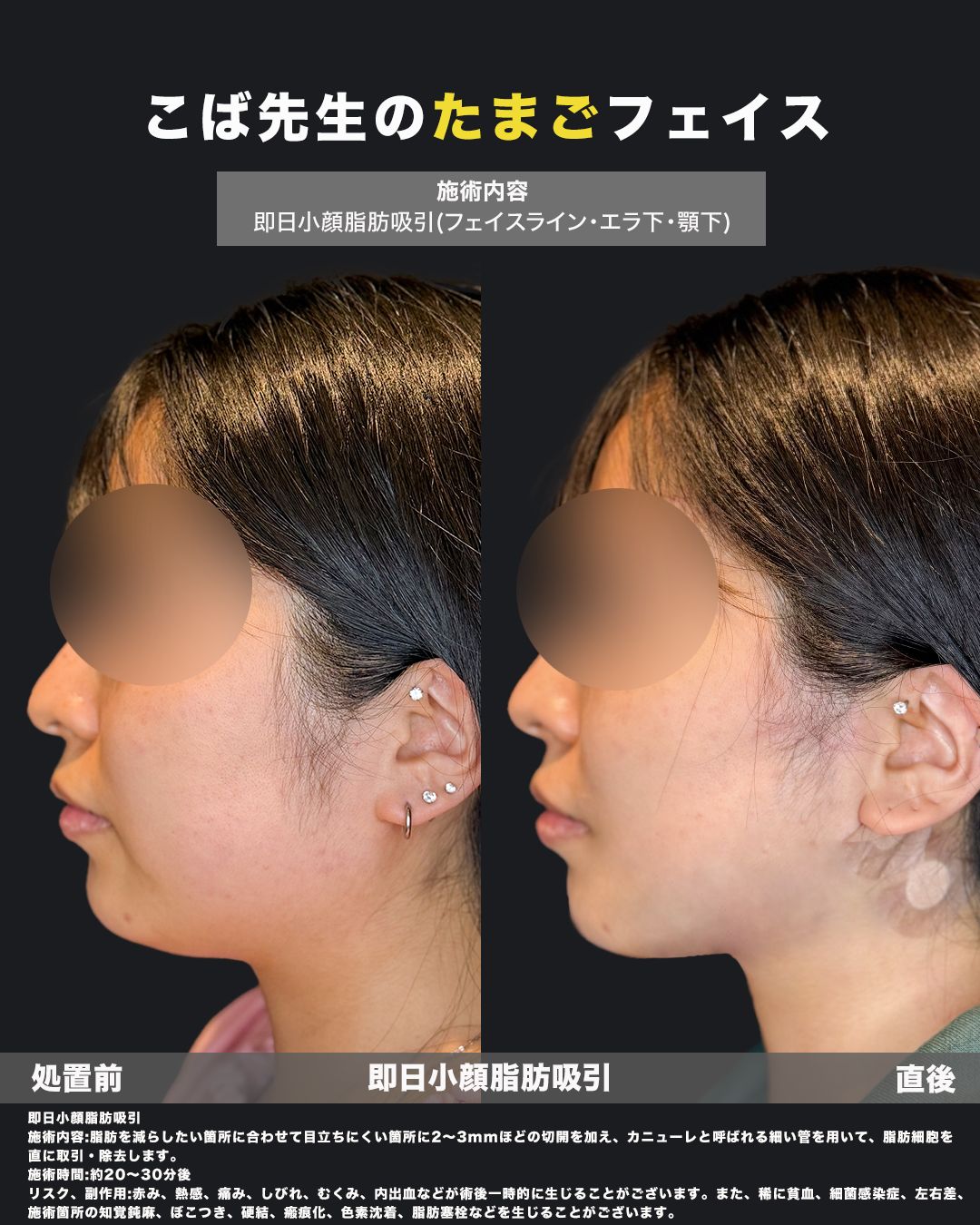 脂肪吸引症例63-横