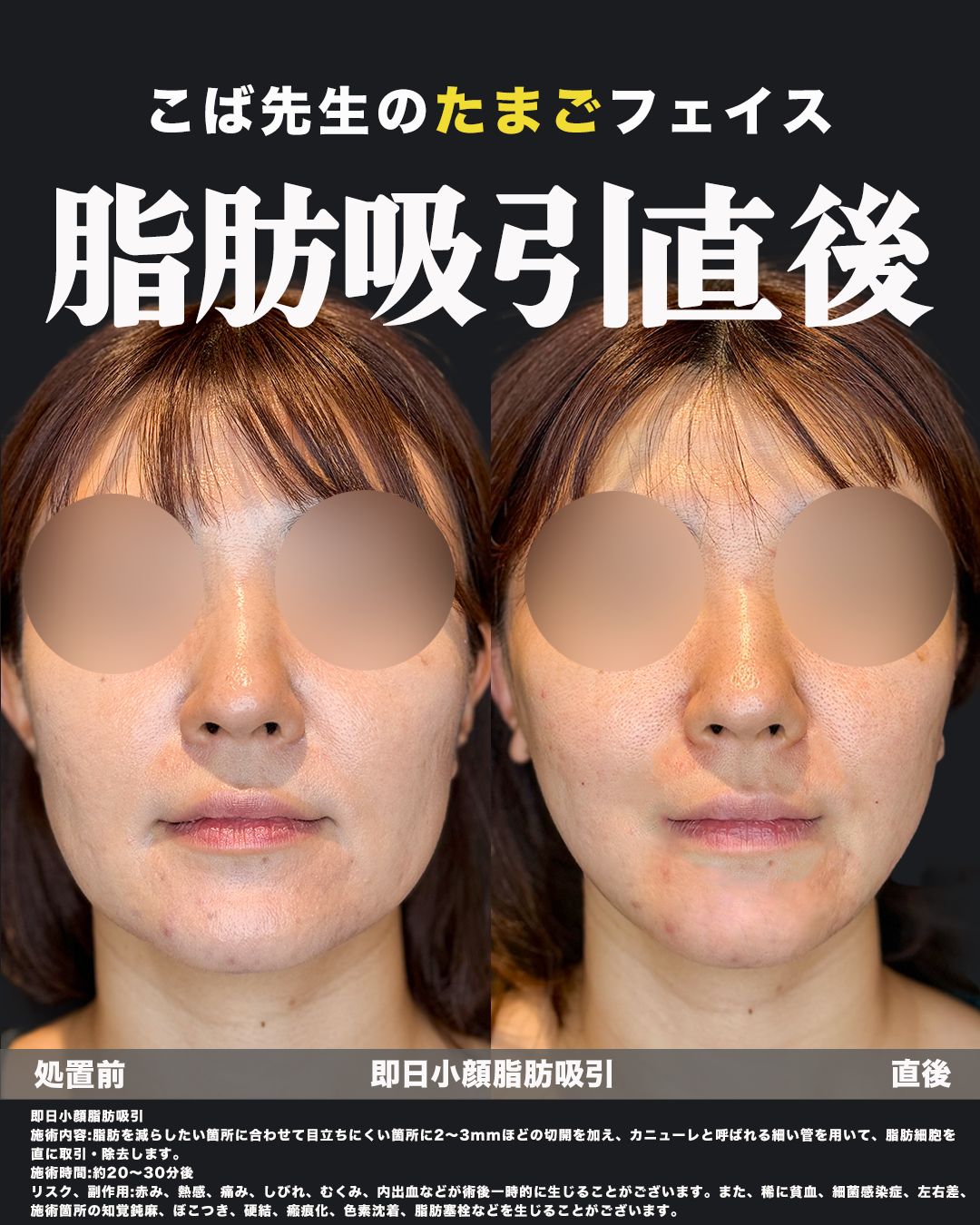 即日脂肪吸引症例63（正面）