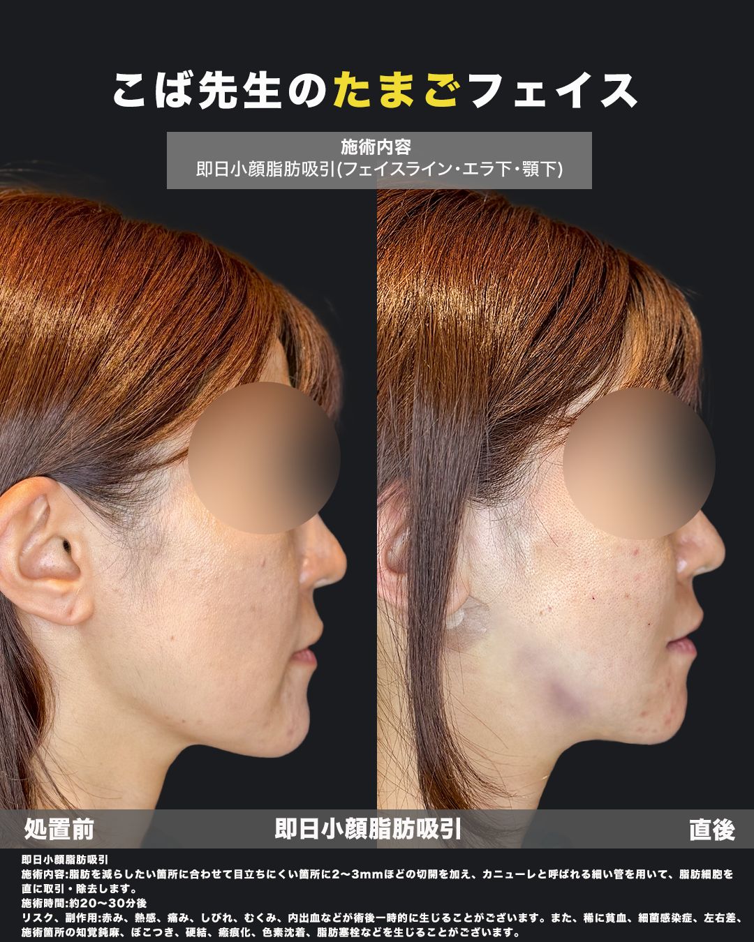 即日脂肪吸引症例63（横）