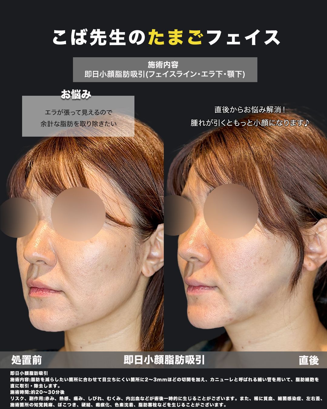 即日脂肪吸引症例63（斜め）