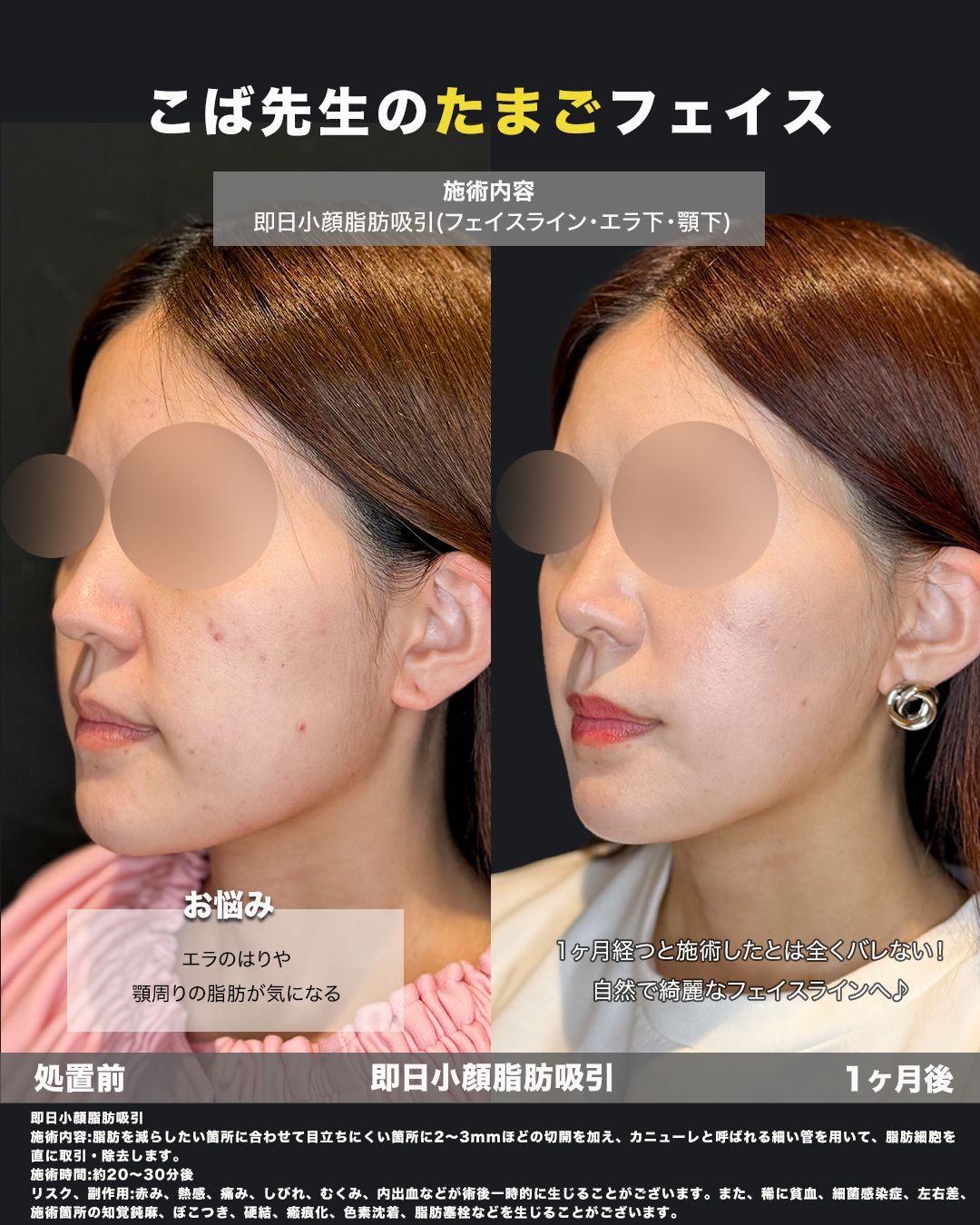 小顔脂肪吸引症例54（斜め）