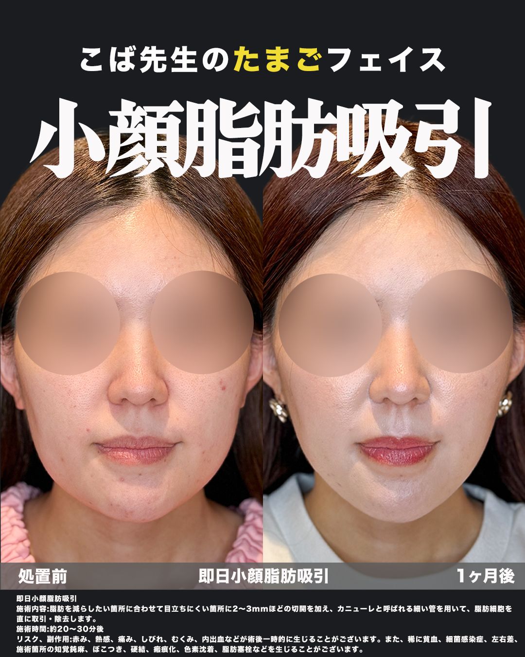 小顔脂肪吸引症例54（正面）