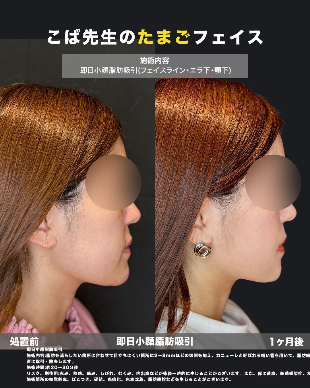 小顔脂肪吸引症例54（横）