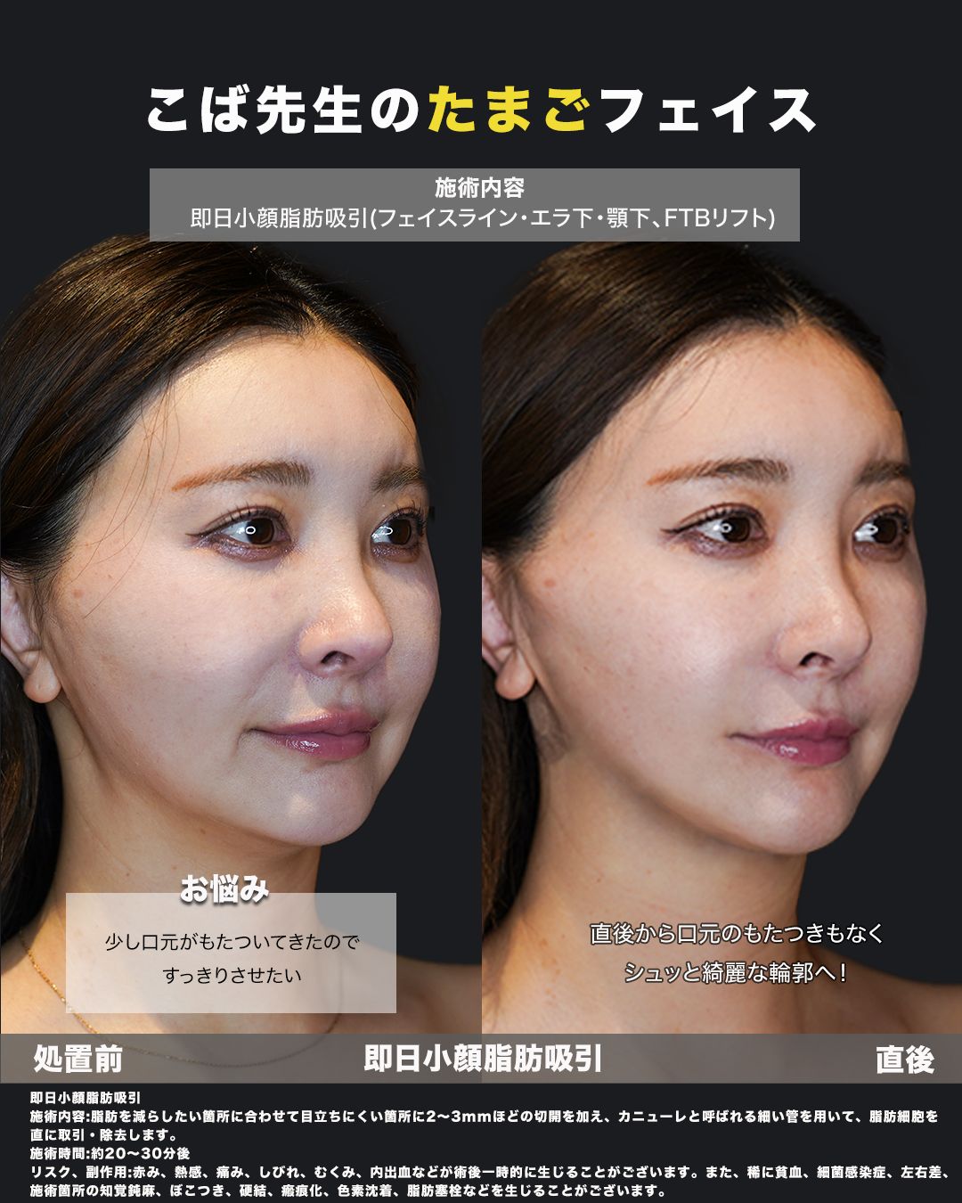 小顔脂肪吸引症例61（斜め）