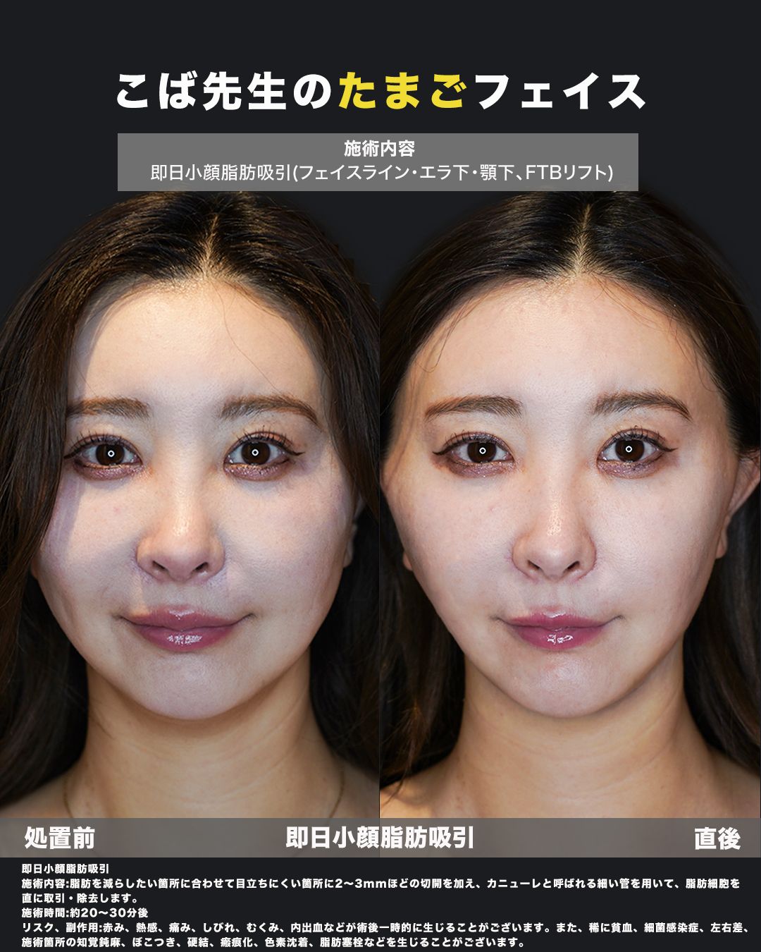 小顔脂肪吸引症例61（正面）