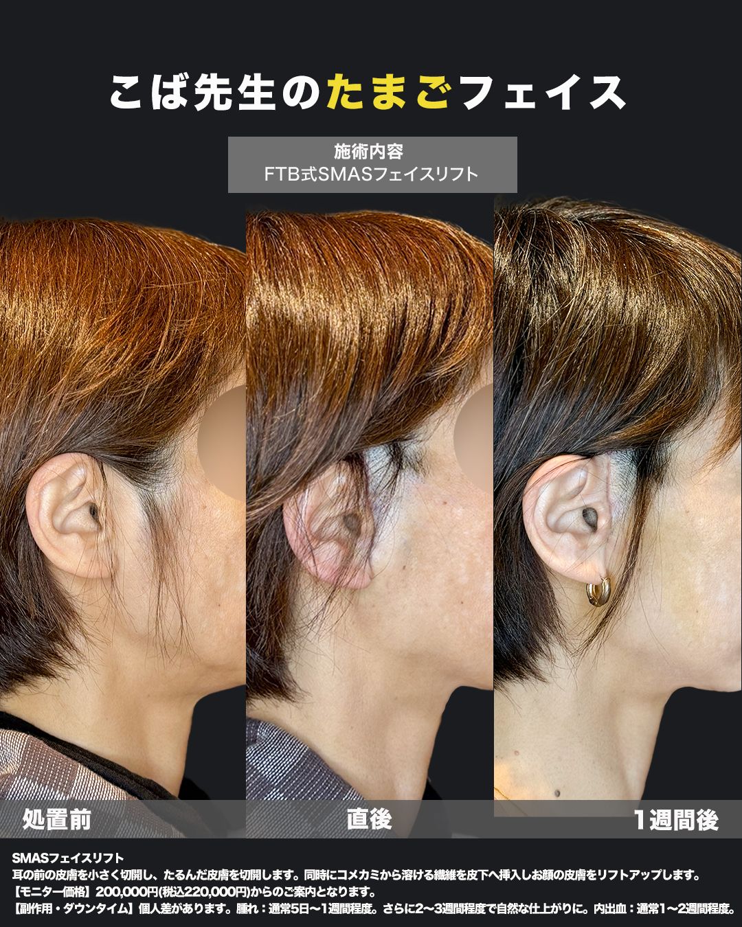 切開式フェイスリフト症例26 - 女性、50代（比較）