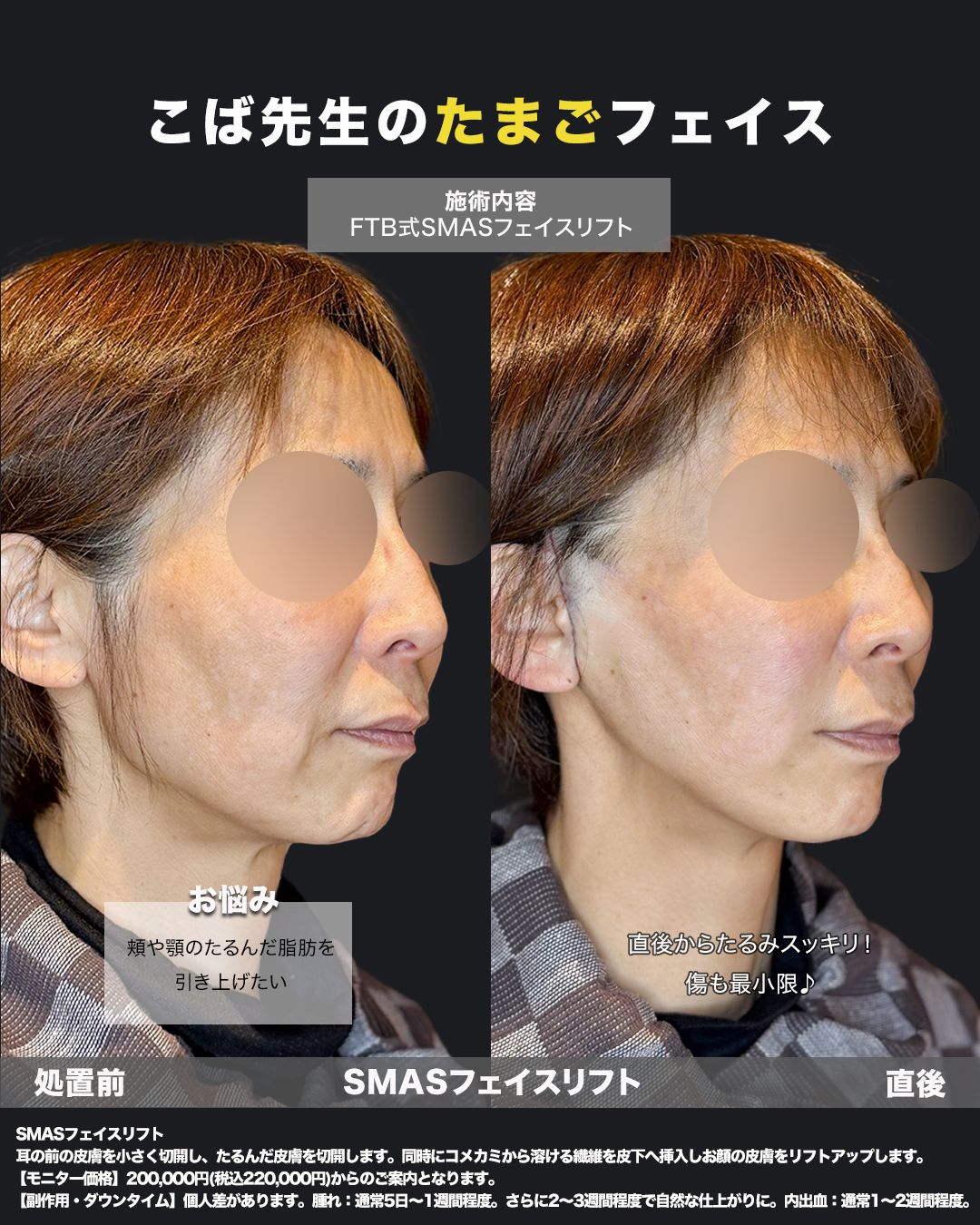 切開式フェイスリフト症例26 - 女性、50代（斜め）