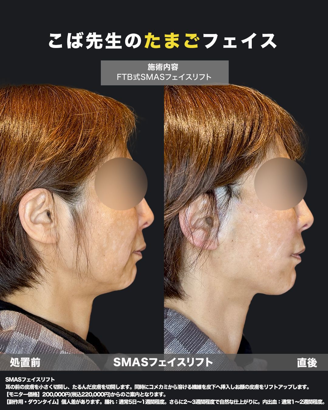 切開式フェイスリフト症例26 - 女性、50代（横）