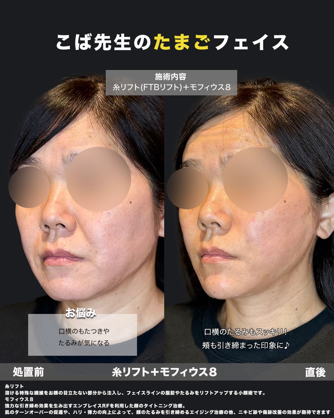 糸リフト＋モフィウス8症例No.40（斜め）