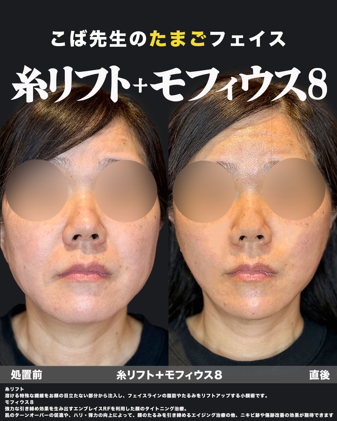 糸リフト＋モフィウス8症例No.40（正面）