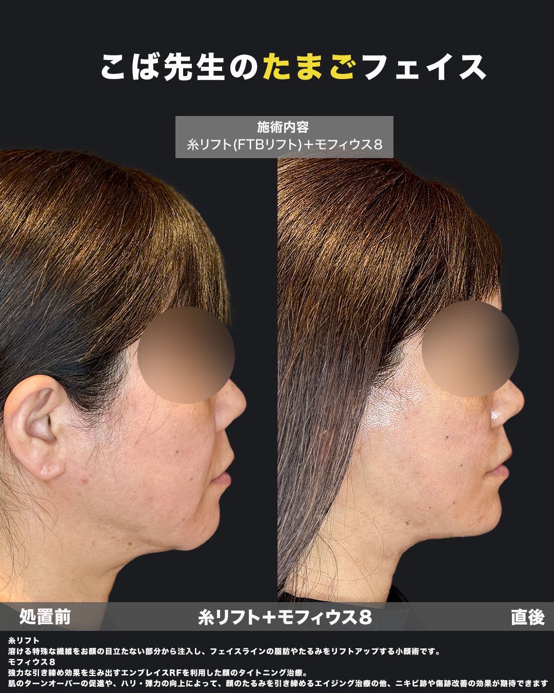 糸リフト＋モフィウス8症例No.40（横）