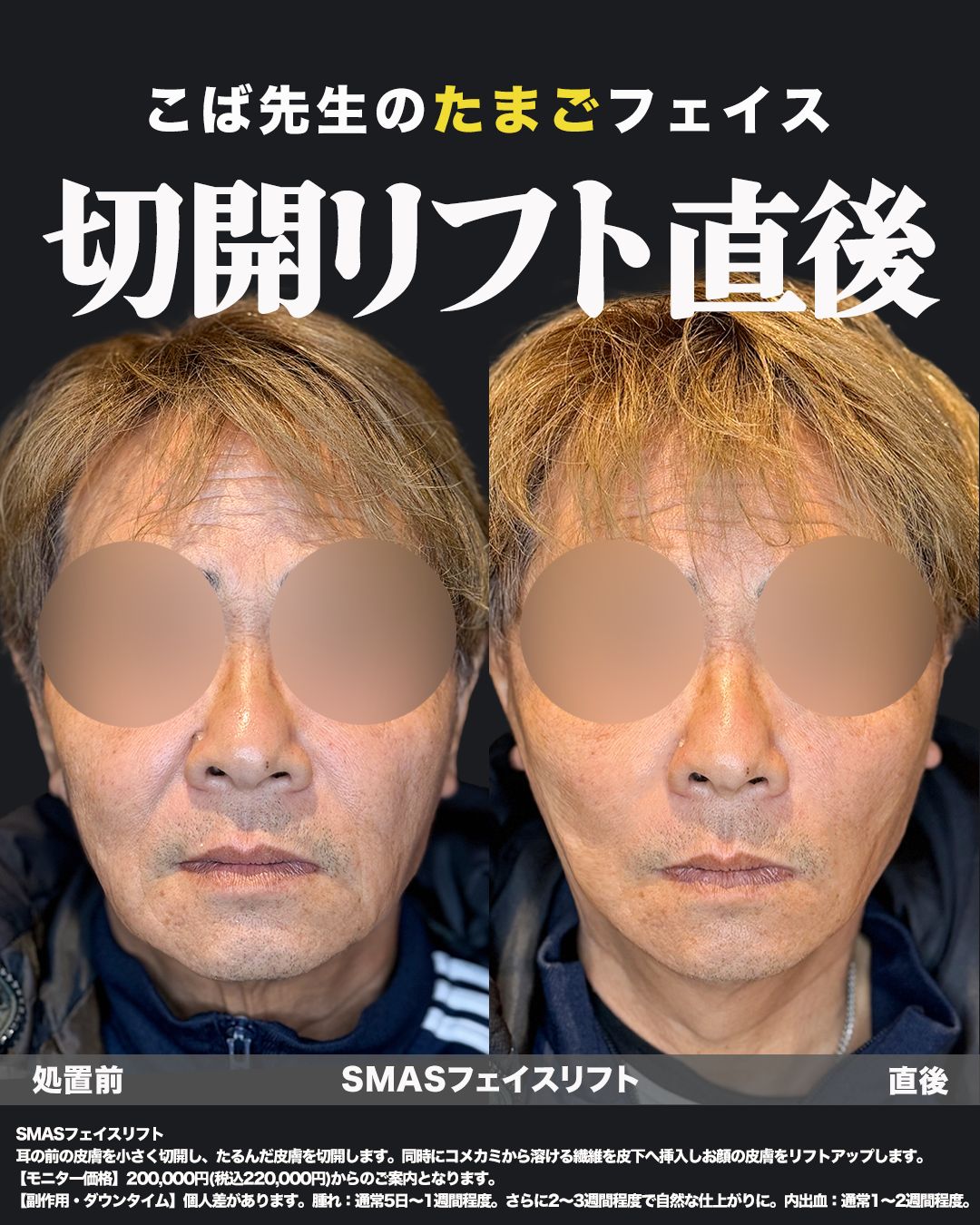 切開リフトの症例-50代男性-正面
