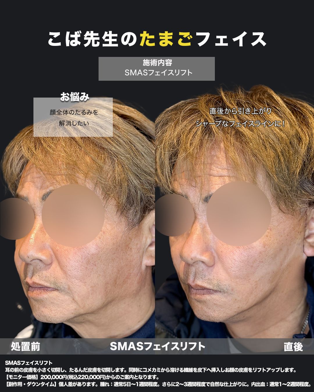 切開リフトの症例-50代男性-斜め