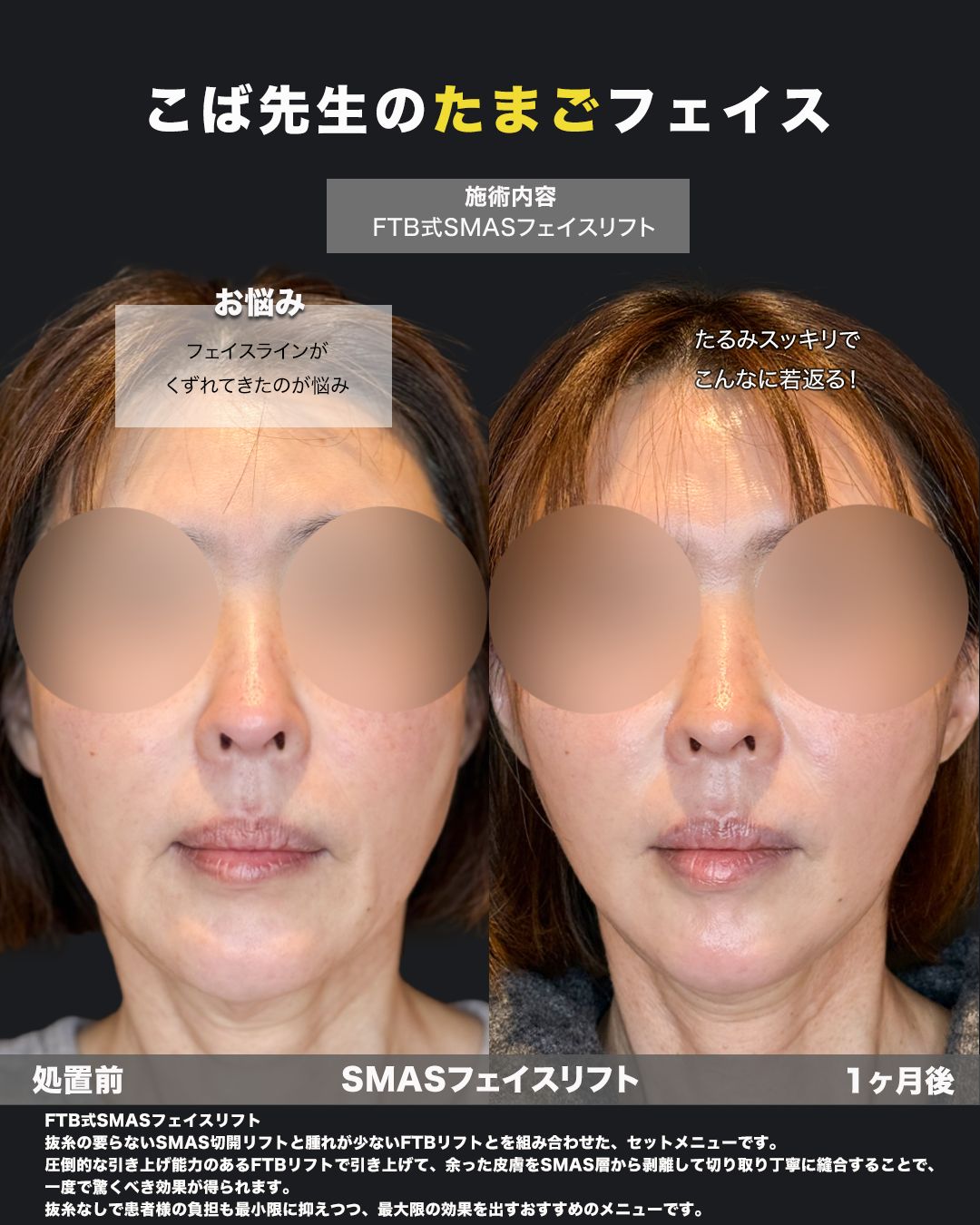 切開リフト症例-50代女性-正面