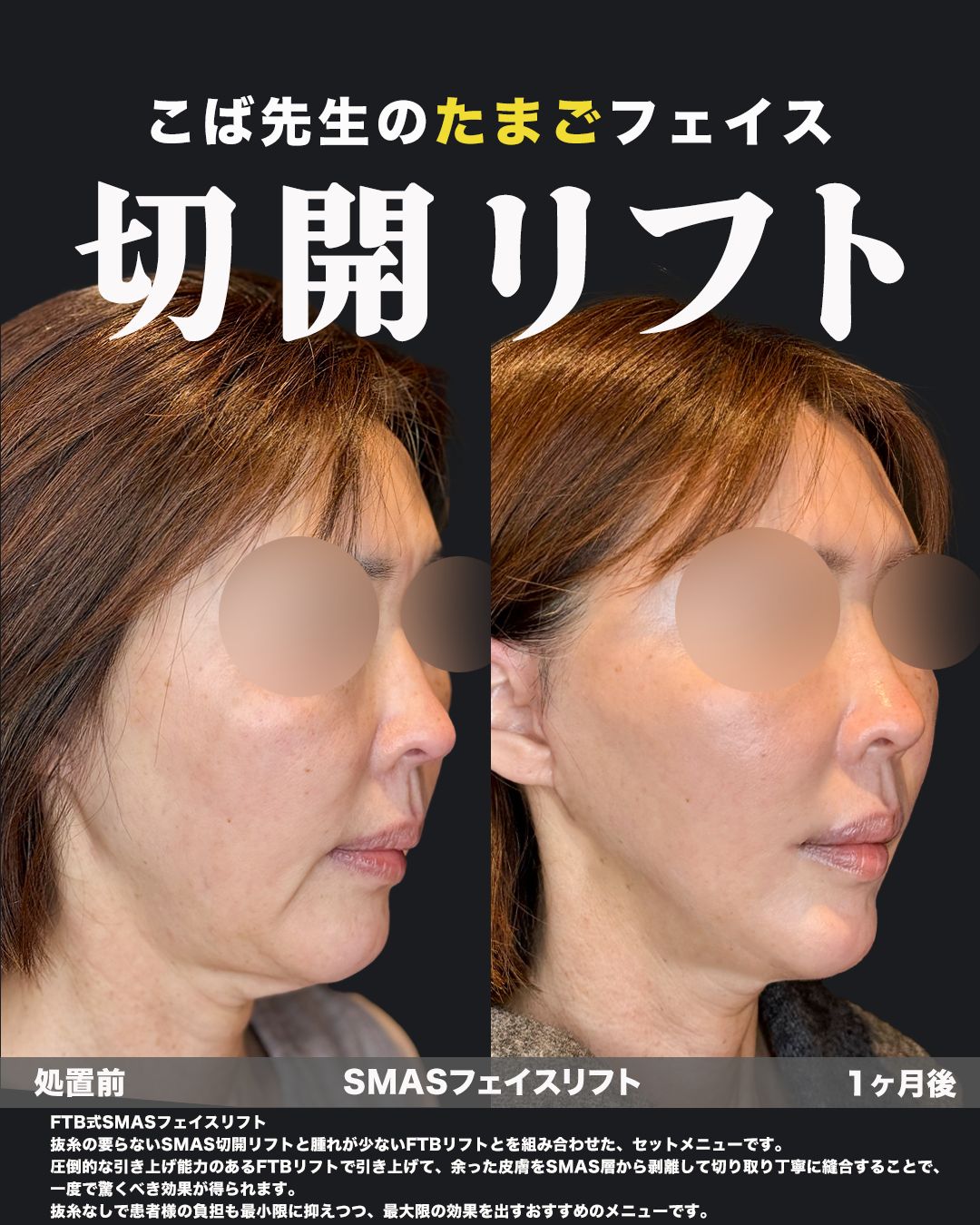 切開リフト症例-50代女性-斜め