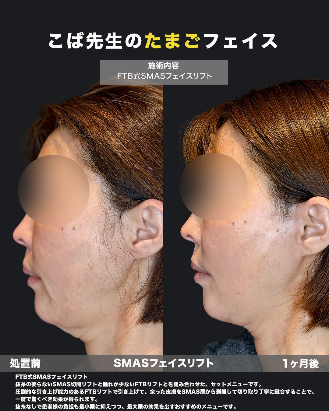 切開リフト症例-50代女性-横