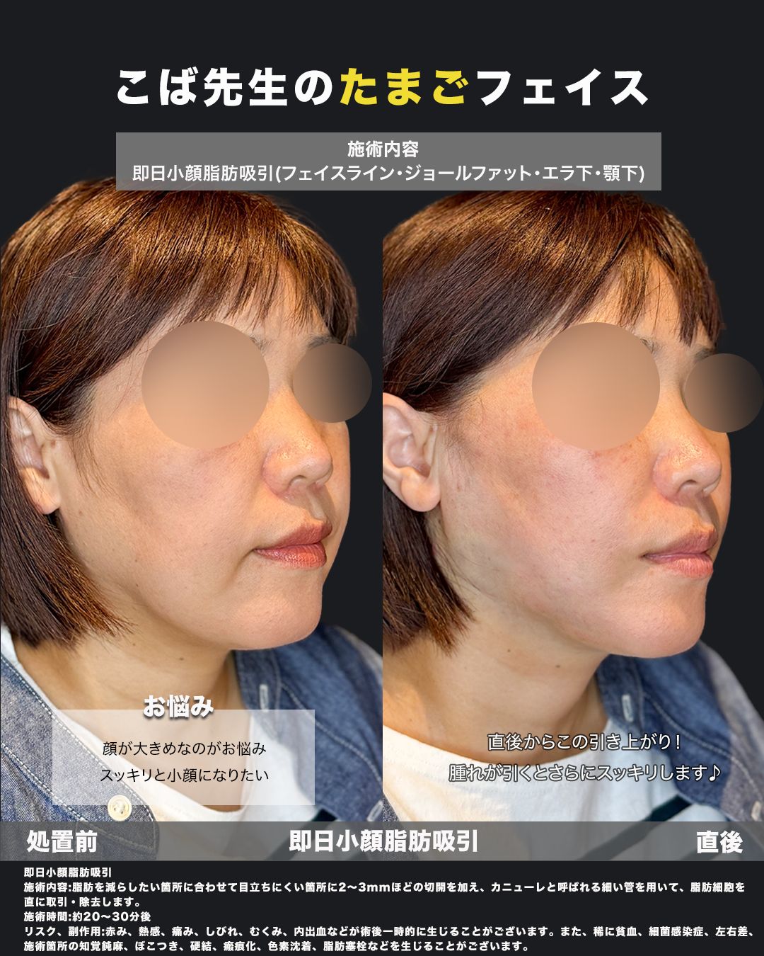 脂肪吸引症例67-40代女性-斜め