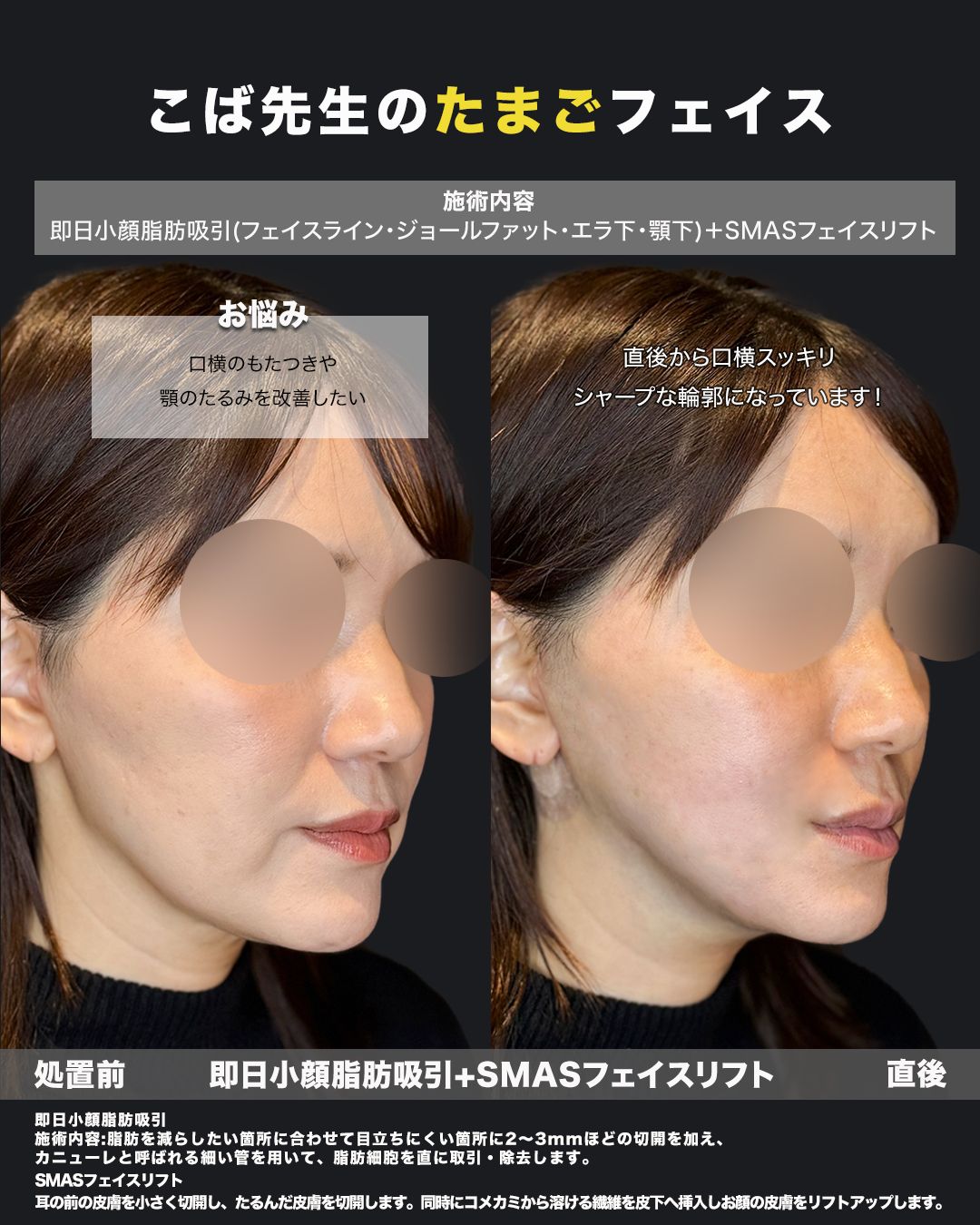 脂肪吸引症例65 _ 40代女性 _ 斜め