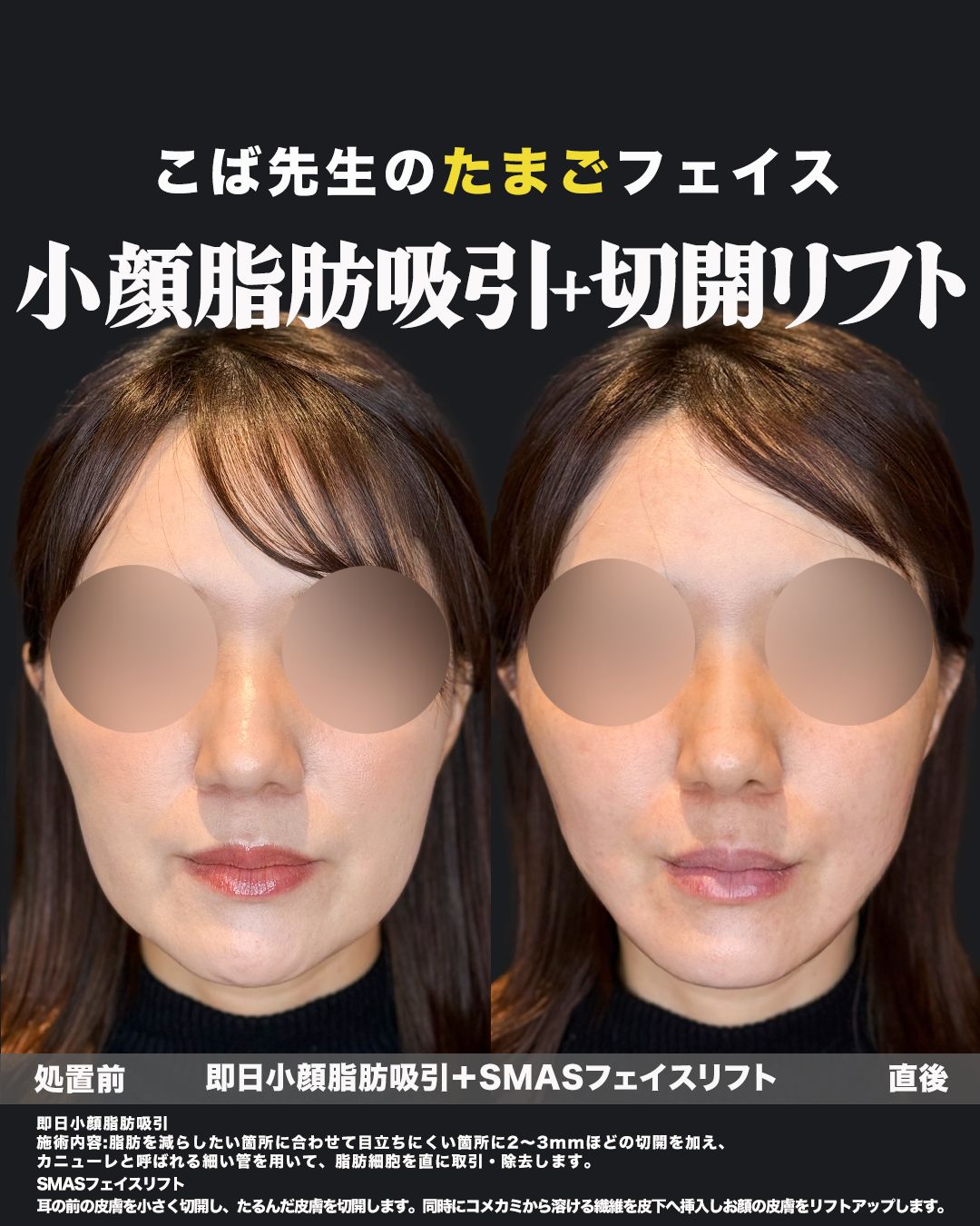 脂肪吸引症例65 _ 40代女性 _ 正面