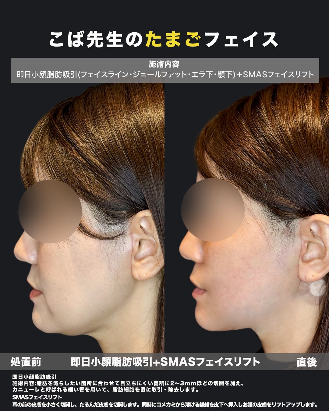 脂肪吸引症例65 _ 40代女性 _ 横