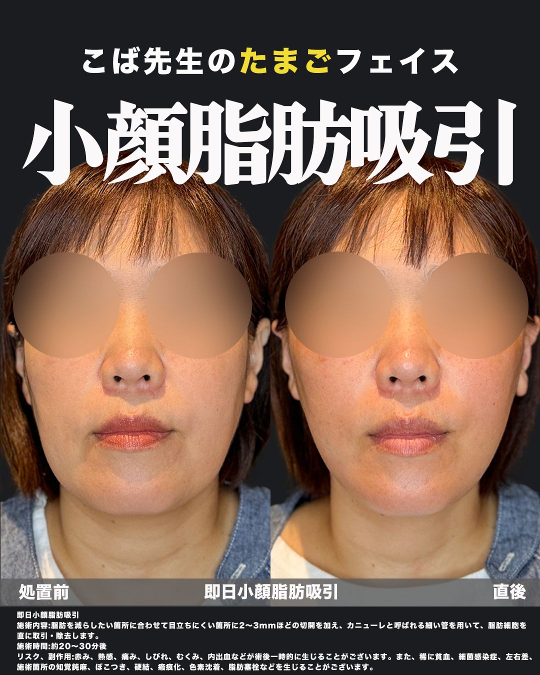 脂肪吸引症例67-40代女性-正面