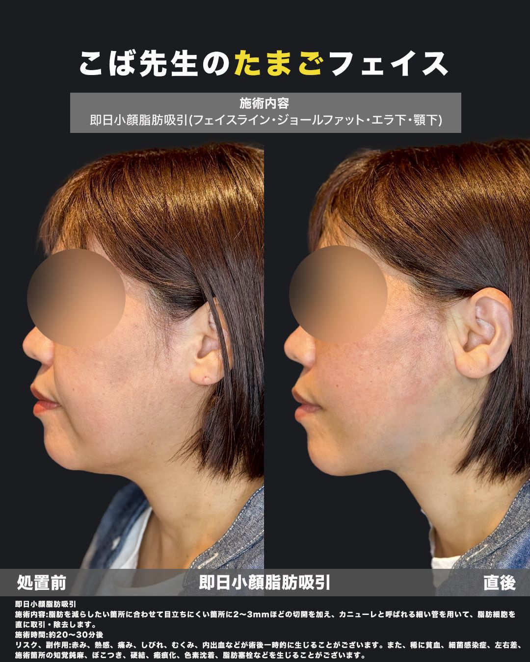 脂肪吸引症例67-40代女性-横