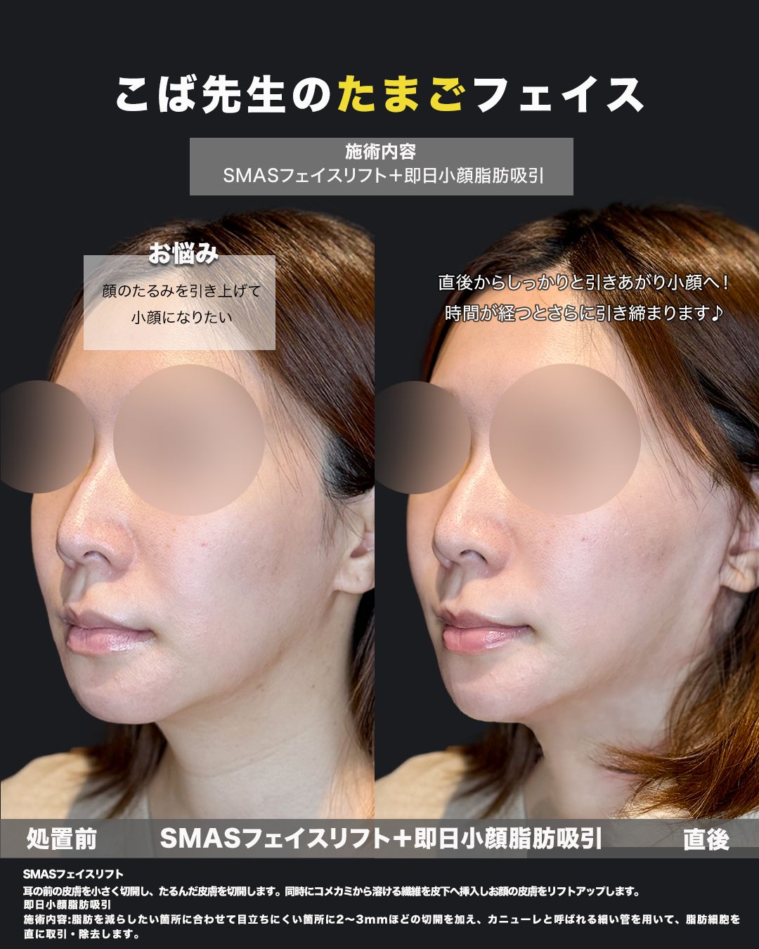 脂肪吸引・切開リフト30代女性-斜め