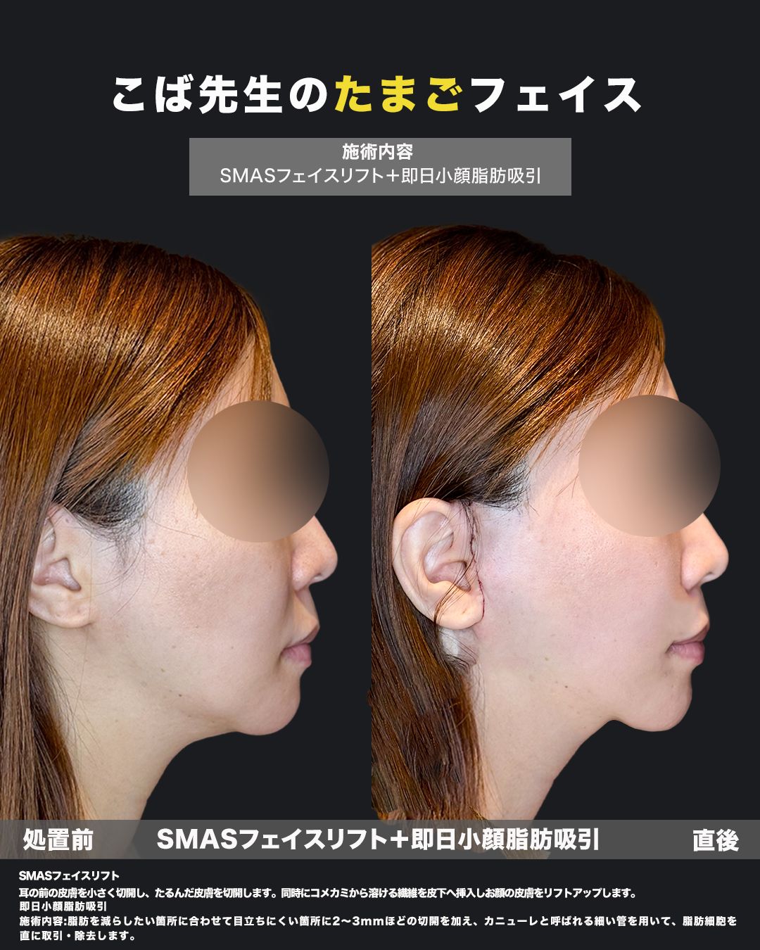 脂肪吸引・切開リフト30代女性-横