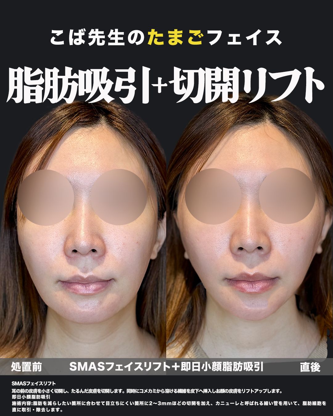 脂肪吸引・切開リフト30代女性-正面