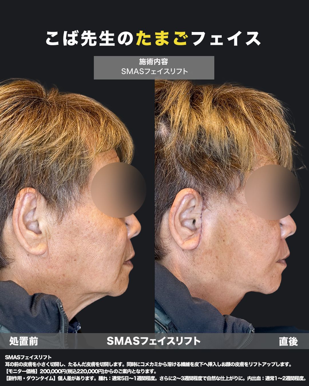 切開リフトの症例-50代男性-横