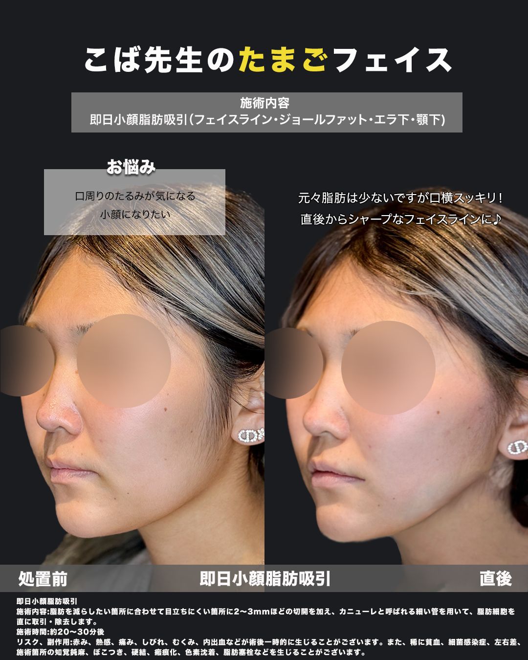 即日小顔脂肪吸引の斜めからのビフォーアフター症例写真