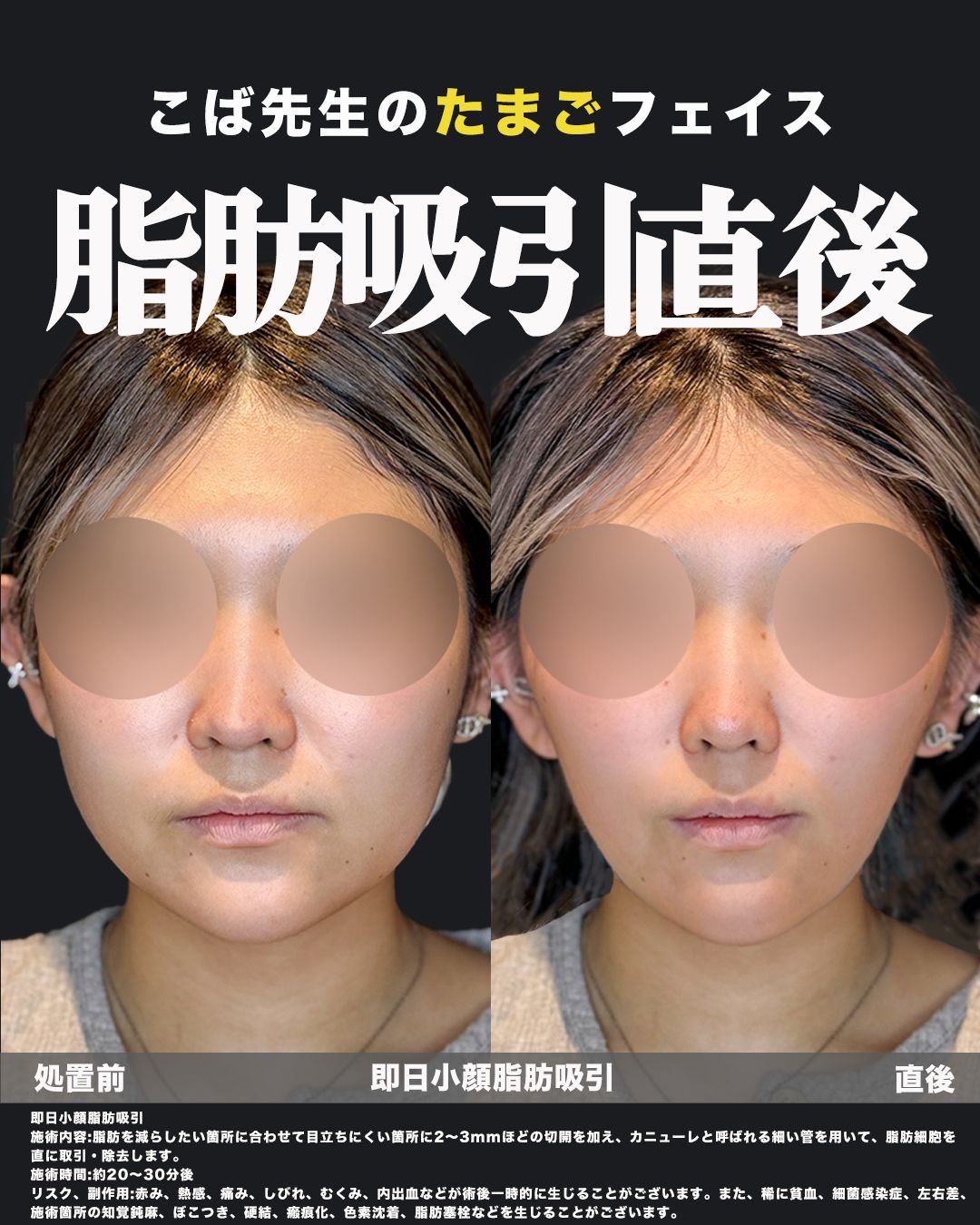 即日小顔脂肪吸引の正面からのビフォーアフター症例写真