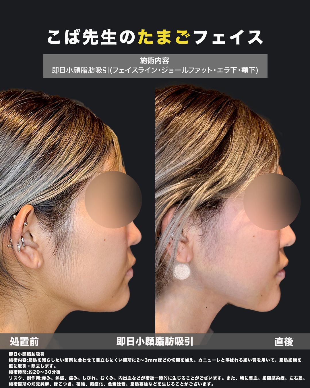 即日小顔脂肪吸引の横顔からのビフォーアフター症例写真