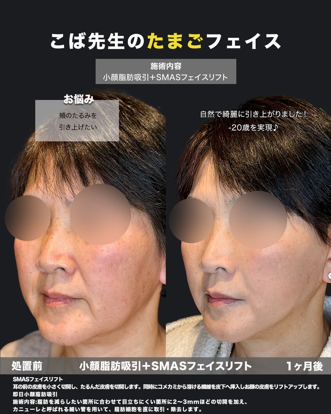 小顔脂肪吸引とSMASフェイスリフトの処置前と1ヶ月後を斜めから比較した症例
