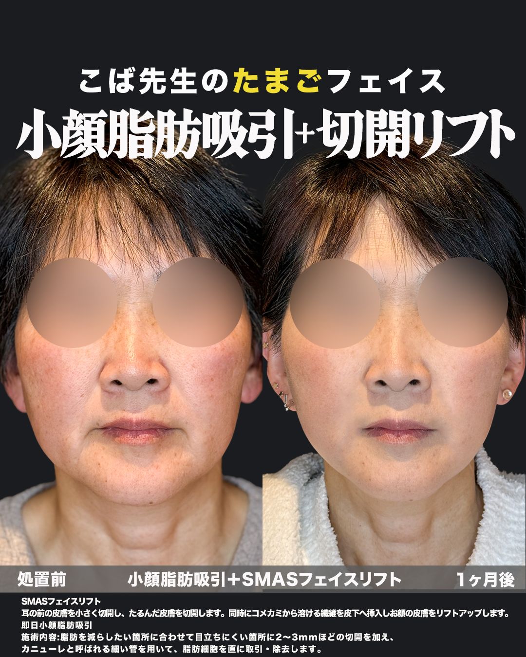 小顔脂肪吸引とSMASフェイスリフトの処置前と1ヶ月後の正面比較症例