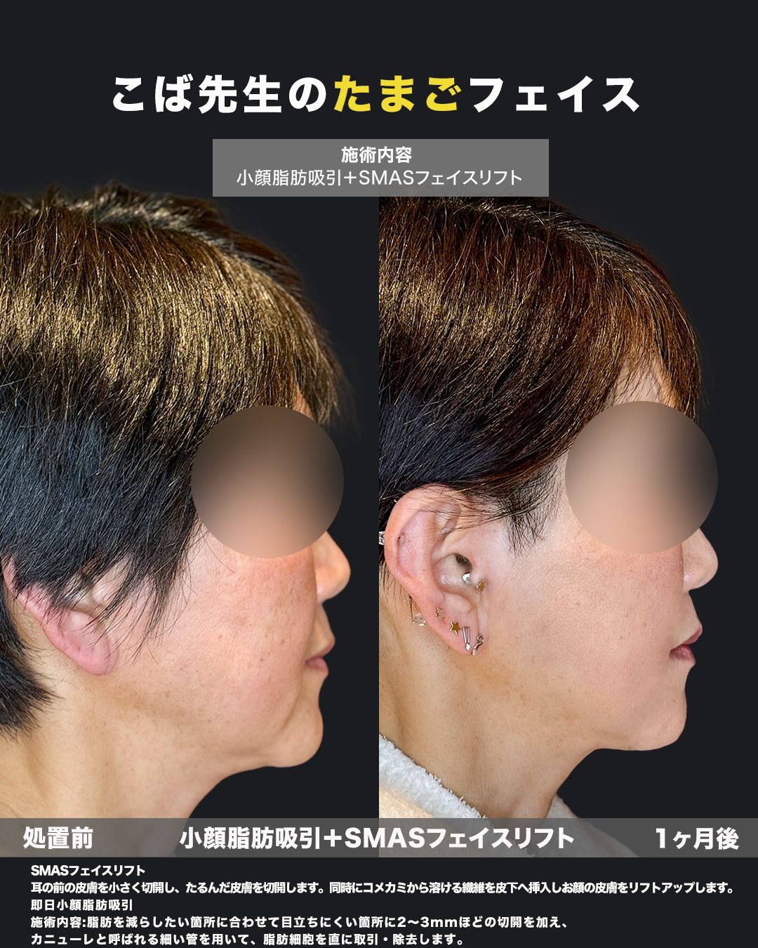 小顔脂肪吸引とSMASフェイスリフトの処置前と1ヶ月後の横顔比較症例